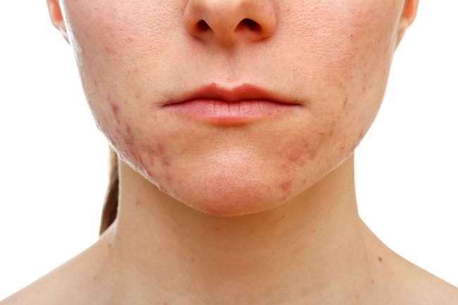 Kulit Breakout Lepas Tukar Skincare – Normal Ke Bahaya?